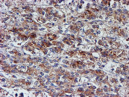 NUBPL Antibody - IHC of paraffin-embedded Carcinoma of Human liver tissue using anti-NUBPL mouse monoclonal antibody. (Heat-induced epitope retrieval by 10mM citric buffer, pH6.0, 100C for 10min).