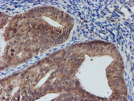 NUBPL Antibody - IHC of paraffin-embedded Adenocarcinoma of Human endometrium tissue using anti-NUBPL mouse monoclonal antibody. (Heat-induced epitope retrieval by 10mM citric buffer, pH6.0, 100C for 10min).