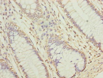 NUBPL Antibody - Immunohistochemistry of paraffin-embedded human colon cancer using NUBPL Antibody at dilution of 1:100