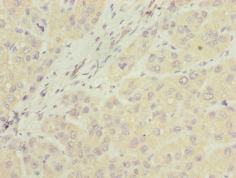 NUBPL Antibody - Immunohistochemistry of paraffin-embedded human liver cancer using NUBPL Antibody at dilution of 1:100