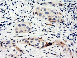NUCB1 / Nucleobindin Antibody - IHC of paraffin-embedded Carcinoma of Human bladder tissue using anti-NUCB1 mouse monoclonal antibody.