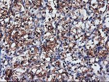 NUCB1 / Nucleobindin Antibody - IHC of paraffin-embedded Carcinoma of Human kidney tissue using anti-NUCB1 mouse monoclonal antibody.