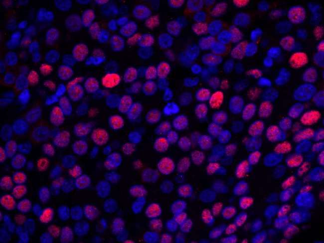 NUCKS1 Antibody - Detection of Human NUCKS by Immunofluorescence. Sample: FFPE section of human breast carcinoma. Antibody: Affinity purified rabbit anti-NUCKS used at a dilution of 1:100. Detection: Red-fluorescent goat anti-rabbit IgG highly cross-adsorbed Antibody Hilyte Plus 555 (A120-501E) used at a dilution of 1:100.
