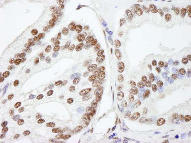 NUCKS1 Antibody - Detection of Human NUCKS by Immunohistochemistry. Sample: FFPE section of human prostate carcinoma. Antibody: Affinity purified rabbit anti-NUCKS used at a dilution of 1:250.