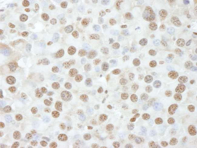NUCKS1 Antibody - Detection of Mouse NUCKS by Immunohistochemistry. Sample: FFPE section of mouse renal cell carcinoma. Antibody: Affinity purified rabbit anti-NUCKS used at a dilution of 1:250.