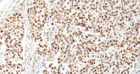NUCKS1 Antibody - Detection of Human NUCKS by Immunohistochemistry. Sample: FFPE section of human breast carcinoma. Antibody: Affinity purified rabbit anti-NUCKS used at a dilution of 1:1000 (1 ug/ml). Detection: DAB.