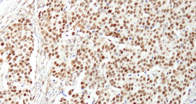 NUCKS1 Antibody - Detection of Human NUCKS by Immunohistochemistry. Sample: FFPE section of human breast carcinoma. Antibody: Affinity purified rabbit anti-NUCKS used at a dilution of 1:1000 (1 ug/ml). Detection: DAB.