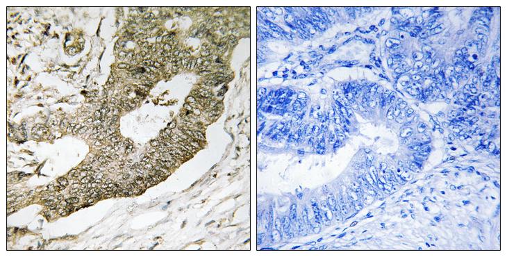 NUCKS1 Antibody - Peptide - + Immunohistochemistry analysis of paraffin-embedded human colon carcinoma tissue using NUCKS1 antibody.