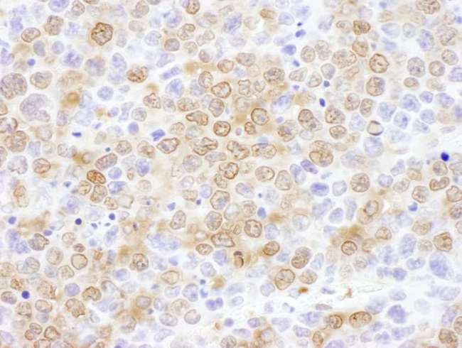 NUDC Antibody - Detection of mouse NUDC by immunohistochemistry. Sample: FFPE section of mouse renal cell carcinoma. Antibody: Affinity purified rabbit anti- NUDC used at a dilution of 1:1,000 (1µg/ml). Detection: DAB