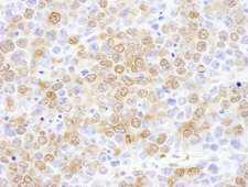 NUDC Antibody - Detection of mouse NUDC by immunohistochemistry. Sample: FFPE section of mouse renal cell carcinoma. Antibody: Affinity purified rabbit anti- NUDC used at a dilution of 1:1,000 (1µg/ml). Detection: DAB