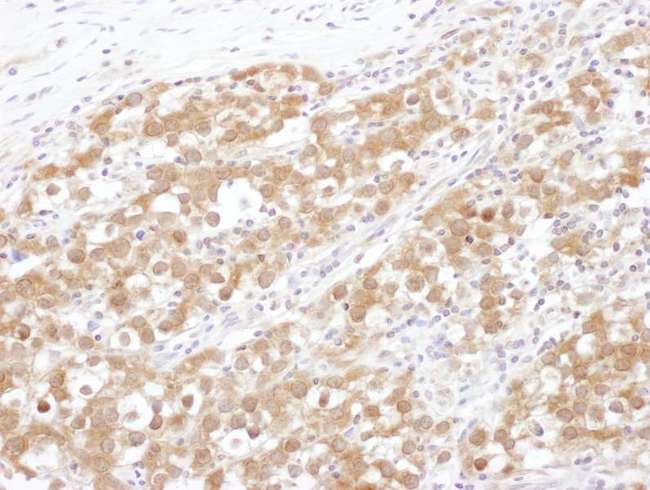 NUDC Antibody - Detection of human NUDC by immunohistochemistry. Sample: FFPE section of human testicular seminoma. Antibody: Affinity purified rabbit anti- NUDC used at a dilution of 1:1,000 (1µg/ml). Detection: DAB