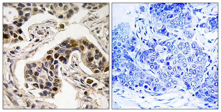 NUDC Antibody - Immunohistochemistry analysis of paraffin-embedded human breast carcinoma, using NudC (Phospho-Ser326) Antibody. The picture on the right is blocked with the phospho peptide.