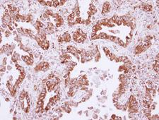 NUDCD1 Antibody - IHC of paraffin-embedded Lung ADCA, using CML66 antibody at 1:500 dilution.