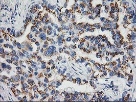 NUDEL / NDEL1 Antibody - IHC of paraffin-embedded Carcinoma of Human lung tissue using anti-NDEL1 mouse monoclonal antibody.