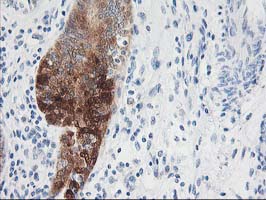 NUDEL / NDEL1 Antibody - IHC of paraffin-embedded Adenocarcinoma of Human endometrium tissue using anti-NDEL1 mouse monoclonal antibody.
