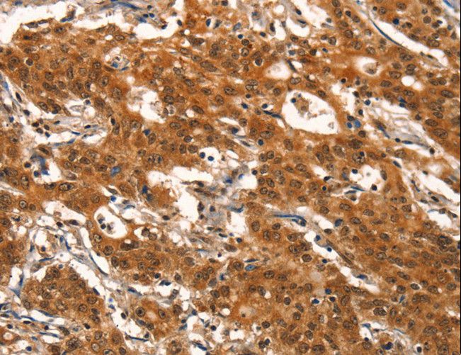 NUDR / DEAF1 Antibody - Immunohistochemistry of paraffin-embedded Human gastric cancer using DEAF1 Polyclonal Antibody at dilution of 1:40.