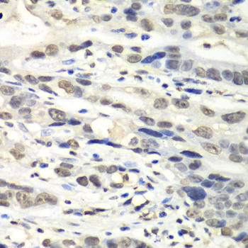 NUDT1 / MTH1 Antibody - Immunohistochemistry of paraffin-embedded human gastric cancer tissue.