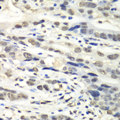 NUDT1 / MTH1 Antibody - Immunohistochemistry of paraffin-embedded human gastric cancer using NUDT1 antibody at dilution of 1:100 (40x lens).