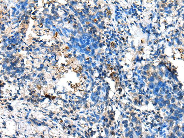 NUDT10 Antibody - Immunohistochemistry of paraffin-embedded Human lung cancer tissue  using NUDT10 Polyclonal Antibody at dilution of 1:70(×200)