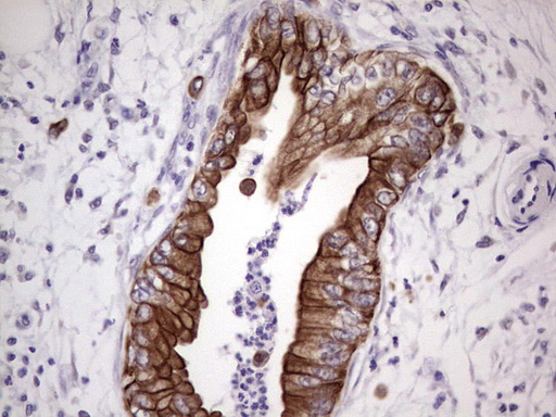 NUDT12 Antibody - Immunohistochemical staining of paraffin-embedded Carcinoma of Human pancreas tissue using anti-NUDT12 mouse monoclonal antibody. (Heat-induced epitope retrieval by 1 mM EDTA in 10mM Tris, pH8.5, 120C for 3min,
