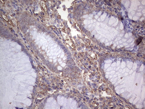 NUDT12 Antibody - Immunohistochemical staining of paraffin-embedded Adenocarcinoma of Human colon tissue using anti-NUDT12 mouse monoclonal antibody. (Heat-induced epitope retrieval by 1 mM EDTA in 10mM Tris, pH8.5, 120C for 3min,