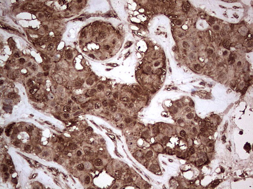 NUDT12 Antibody - Immunohistochemical staining of paraffin-embedded Carcinoma of Human liver tissue using anti-NUDT12 mouse monoclonal antibody. (Heat-induced epitope retrieval by 1 mM EDTA in 10mM Tris, pH8.5, 120C for 3min,