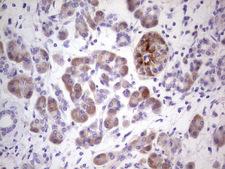 NUDT12 Antibody - IHC of paraffin-embedded Carcinoma of Human pancreas tissue using anti-NUDT12 mouse monoclonal antibody. (Heat-induced epitope retrieval by 1 mM EDTA in 10mM Tris, pH8.5, 120°C for 3min).