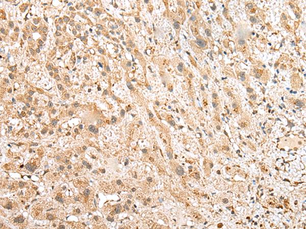 NUDT12 Antibody - Immunohistochemistry of paraffin-embedded Human liver cancer tissue  using NUDT12 Polyclonal Antibody at dilution of 1:25(×200)