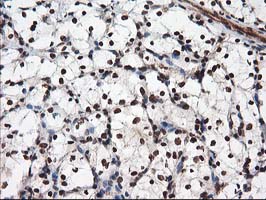 NUDT18 Antibody - IHC of paraffin-embedded Carcinoma of Human kidney tissue using anti-NUDT18 mouse monoclonal antibody.