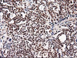 NUDT18 Antibody - IHC of paraffin-embedded Adenocarcinoma of Human ovary tissue using anti-NUDT18 mouse monoclonal antibody.