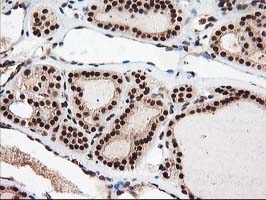 NUDT18 Antibody - IHC of paraffin-embedded Carcinoma of Human thyroid tissue using anti-NUDT18 mouse monoclonal antibody.