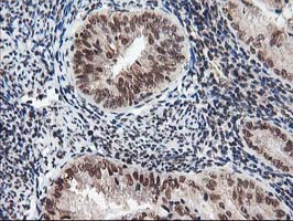 NUDT18 Antibody - IHC of paraffin-embedded Adenocarcinoma of Human endometrium tissue using anti-NUDT18 mouse monoclonal antibody.