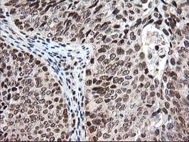 NUDT18 Antibody - IHC of paraffin-embedded Carcinoma of Human bladder tissue using anti-NUDT18 mouse monoclonal antibody.
