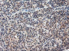 NUDT18 Antibody - IHC of paraffin-embedded Human lymphoma tissue using anti-NUDT18 mouse monoclonal antibody.