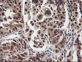 NUDT18 Antibody - IHC of paraffin-embedded Carcinoma of Human lung tissue using anti-NUDT18 mouse monoclonal antibody.
