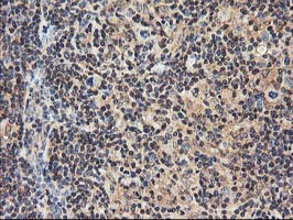 NUDT18 Antibody - IHC of paraffin-embedded Human lymphoma tissue using anti-NUDT18 mouse monoclonal antibody.