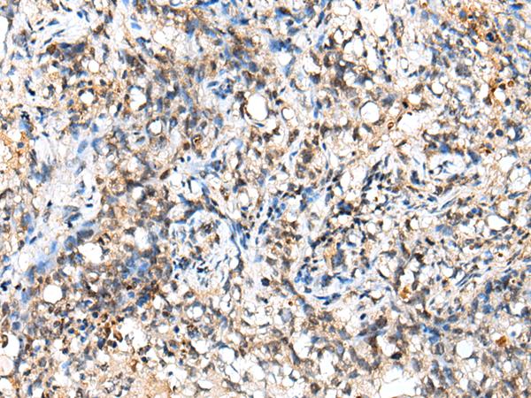 NUDT18 Antibody - Immunohistochemistry of paraffin-embedded Human lung cancer tissue  using NUDT18 Polyclonal Antibody at dilution of 1:40(×200)
