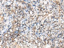NUDT18 Antibody - Immunohistochemistry of paraffin-embedded Human lung cancer tissue  using NUDT18 Polyclonal Antibody at dilution of 1:40(×200)