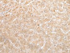 NUDT19 Antibody - Immunohistochemistry of paraffin-embedded Human liver cancer tissue  using NUDT19 Polyclonal Antibody at dilution of 1:25(×200)