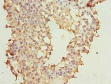 NUDT2 Antibody - Immunohistochemistry of paraffin-embedded human breast cancer at dilution 1:100