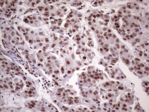 NUDT21 Antibody - IHC of paraffin-embedded Carcinoma of Human liver tissue using anti-NUDT21 mouse monoclonal antibody. (Heat-induced epitope retrieval by 1 mM EDTA in 10mM Tris, pH8.5, 120°C for 3min)(1:150).