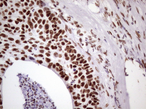 NUDT21 Antibody - IHC of paraffin-embedded Carcinoma of Human lung tissue using anti-NUDT21 mouse monoclonal antibody. (Heat-induced epitope retrieval by 1 mM EDTA in 10mM Tris, pH8.5, 120°C for 3min)(1:150).