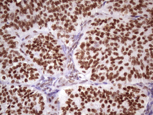 NUDT21 Antibody - IHC of paraffin-embedded Adenocarcinoma of Human ovary tissue using anti-NUDT21 mouse monoclonal antibody. (Heat-induced epitope retrieval by 1 mM EDTA in 10mM Tris, pH8.5, 120°C for 3min)(1:150).