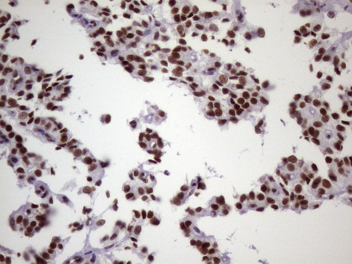 NUDT21 Antibody - IHC of paraffin-embedded Carcinoma of Human pancreas tissue using anti-NUDT21 mouse monoclonal antibody. (Heat-induced epitope retrieval by 1 mM EDTA in 10mM Tris, pH8.5, 120°C for 3min)(1:150).