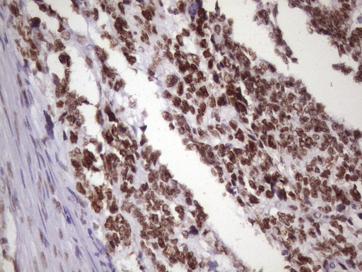 NUDT21 Antibody - IHC of paraffin-embedded Adenocarcinoma of Human endometrium tissue using anti-NUDT21 mouse monoclonal antibody. (Heat-induced epitope retrieval by 1 mM EDTA in 10mM Tris, pH8.5, 120°C for 3min)(1:150).