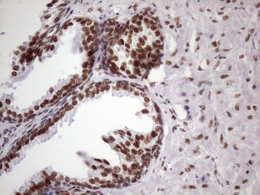 NUDT21 Antibody - IHC of paraffin-embedded Human prostate tissue using anti-NUDT21 mouse monoclonal antibody. (Heat-induced epitope retrieval by 1 mM EDTA in 10mM Tris, pH8.5, 120°C for 3min)(1:150).