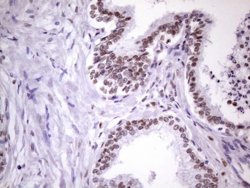 NUDT21 Antibody - IHC of paraffin-embedded Carcinoma of Human prostate tissue using anti-NUDT21 mouse monoclonal antibody. (Heat-induced epitope retrieval by 1 mM EDTA in 10mM Tris, pH8.5, 120°C for 3min)(1:150).