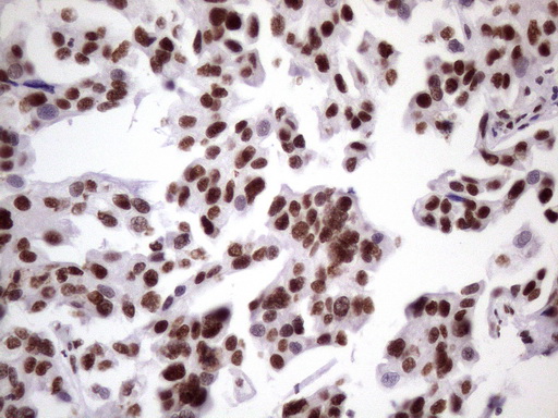 NUDT21 Antibody - IHC of paraffin-embedded Carcinoma of Human bladder tissue using anti-NUDT21 mouse monoclonal antibody. (Heat-induced epitope retrieval by 1 mM EDTA in 10mM Tris, pH8.5, 120°C for 3min)(1:150).