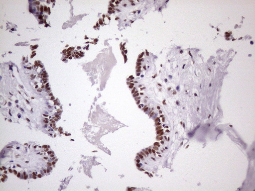 NUDT21 Antibody - Immunohistochemical staining of paraffin-embedded Human breast tissue within the normal limits using anti-NUDT21 mouse monoclonal antibody. (Heat-induced epitope retrieval by 1 mM EDTA in 10mM Tris, pH8.5, 120C for 3min. (1:150)