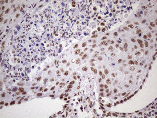 NUDT21 Antibody - Immunohistochemical staining of paraffin-embedded Carcinoma of Human lung tissue using anti-NUDT21 mouse monoclonal antibody. (Heat-induced epitope retrieval by 1 mM EDTA in 10mM Tris, pH8.5, 120C for 3min. (1:150)